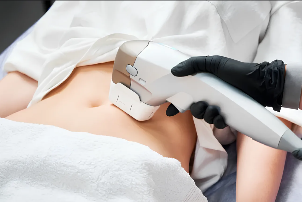 SMAS-лифтинг по телу